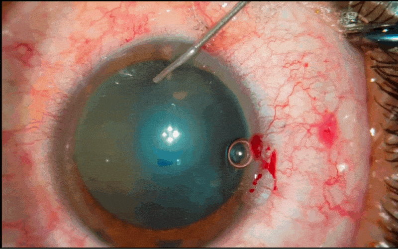 Motion image of cataract surgery on human eye.