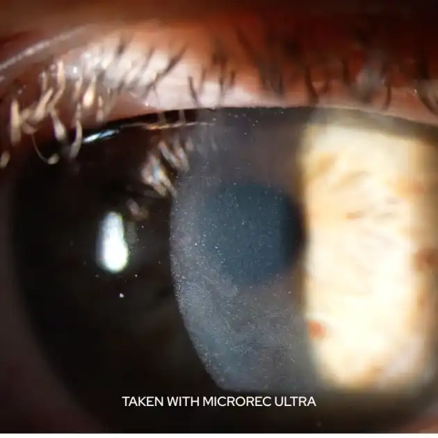 Slit lamp photo of an eye taken with MicroREC Ultra, showcasing image clarity and detail